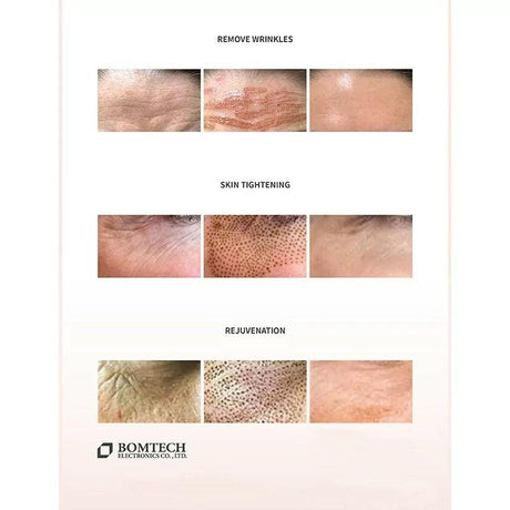 BOMTECH Renouveau Plasma Pen - BVShop